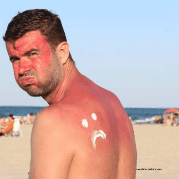 Severe sun poisoning on skin
